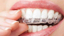 invisalign-smile